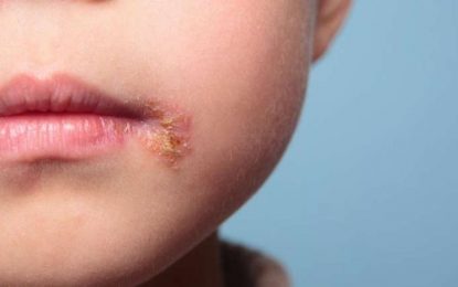 Declarats 17 brots d’impetigen en escoles catalanes, dos al Maresme
